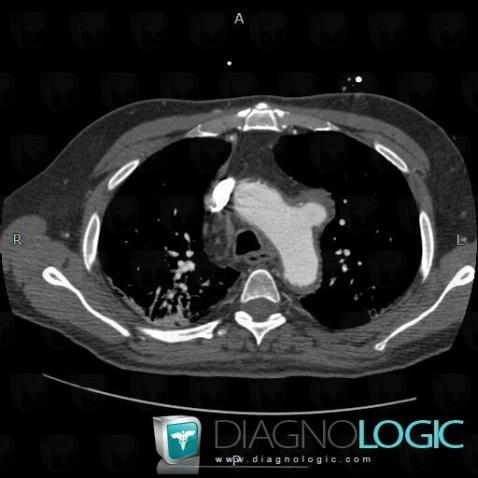 Aneurysm, Mediastinum, CT