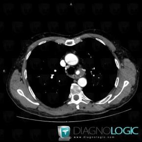 Aneurysm, Mediastinum, Other arteries - Thorax, CT