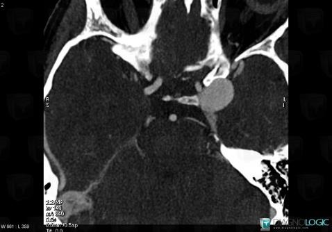 Aneurysm, Pituitary gland and parasellar region, Internal carotid artery, CT