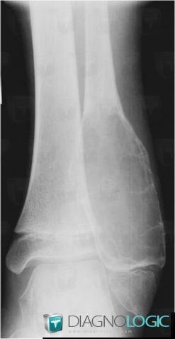 Aneurysmal bone cyst, Fibula - Distal part, X rays