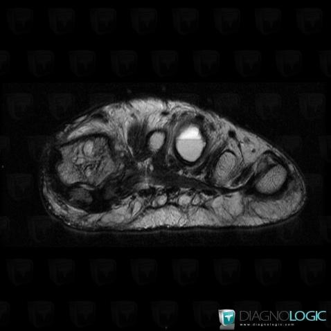 Aneurysmal bone cyst, Metatarsal bones, MRI