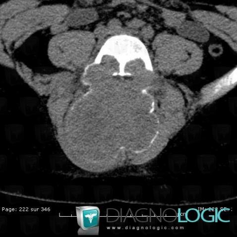 Aneurysmal bone cyst, Paraspinal, CT
