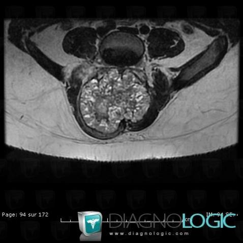 Aneurysmal bone cyst, Paraspinal, MRI