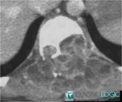 Aneurysmal bone cyst, Vertebral body / Disk, CT