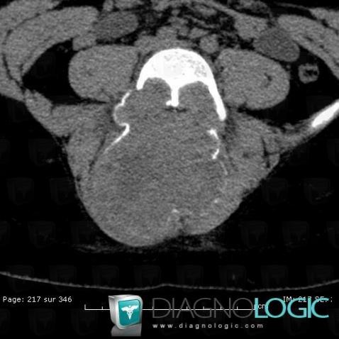 Aneurysmal bone cyst, Vertebral body / Disk, Spinal canal / Cord, CT