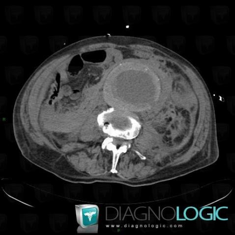 Anévrisme rompu, Aorte abdominale, Scanner