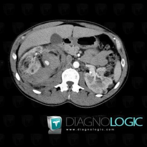 Anévrisme rompu, Branches-l aorte abdominale, Scanner