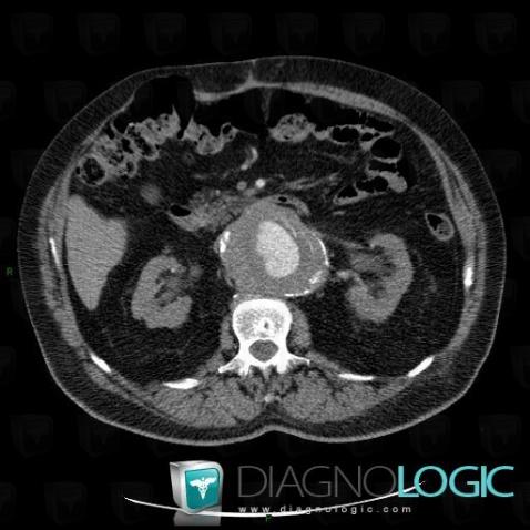 Anévrysme, Aorte abdominale, Scanner