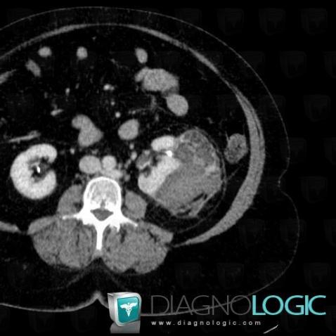 Angiomyolipoma, Kidney, CT