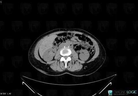 Angiomyolipoma, Kidney, CT