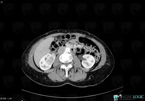 Angiomyolipoma, Kidney, CT