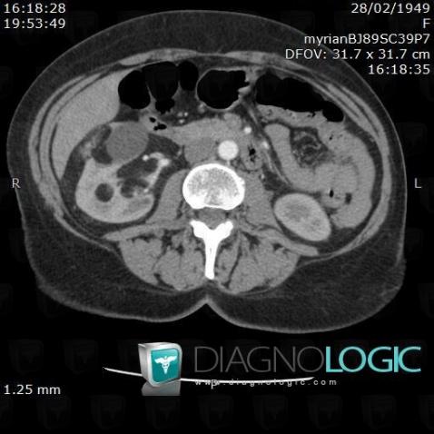 Angiomyolipoma, Kidney, CT