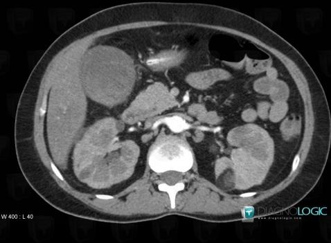 Angiomyolipoma, Kidney, CT