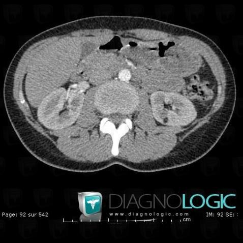 Angiomyolipoma, Kidney, CT