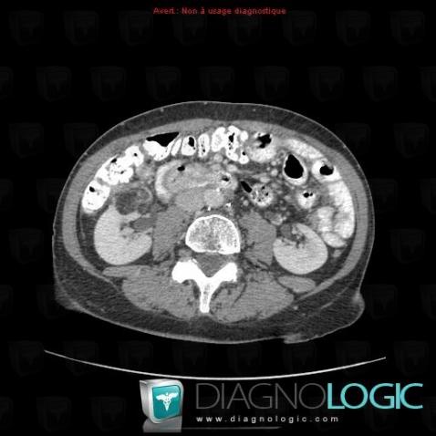 Angiomyolipoma, Kidney, CT