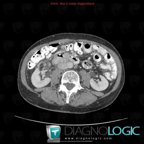 Angiomyolipoma, Kidney, CT