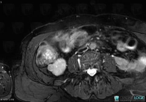 Angiomyolipoma, Kidney, MRI