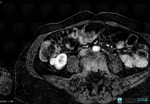 Angiomyolipoma, Kidney, MRI