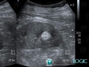 Angiomyolipoma, Kidney, US