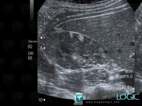 Angiomyolipoma, Kidney, US