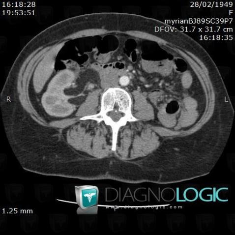 Angiomyolipoma, Retroperitoneum, CT