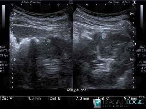 Angiomyolipome, Rein, Echographie