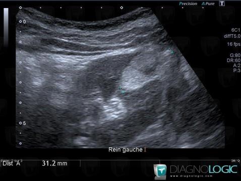 Angiomyolipome, Rein, Echographie