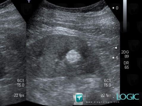 Angiomyolipome, Rein, Echographie