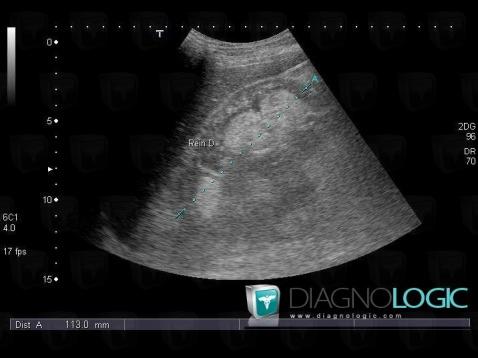 Angiomyolipome, Rein, Echographie