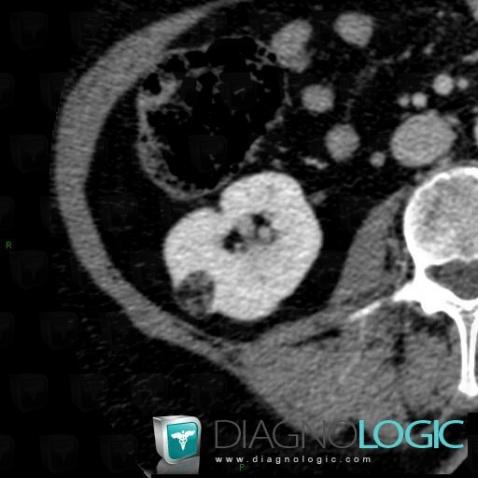 Angiomyolipome, Rein, Scanner