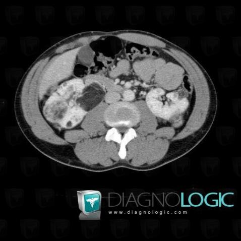 Angiomyolipome, Rein, Scanner