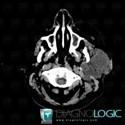 Angiosarcoma, Deep facial spaces, Soft tissues - Head and neck, CT