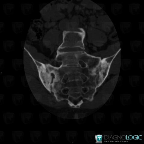 Ankylosing spondylitis, Sacro iliac joint, CT