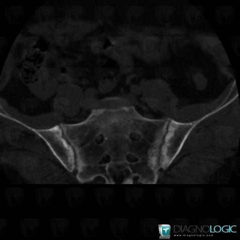 Ankylosing spondylitis, Sacro iliac joint, CT