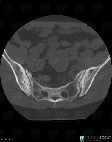 Ankylosing spondylitis, Sacro iliac joint, CT