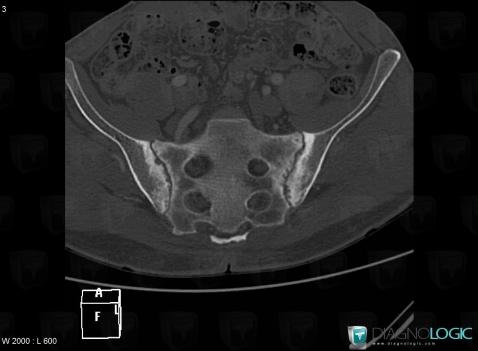 Ankylosing spondylitis, Sacro iliac joint, CT