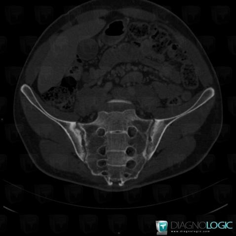 Ankylosing spondylitis, Sacro iliac joint, CT