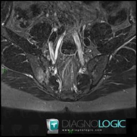 Ankylosing spondylitis, Sacro iliac joint, MRI