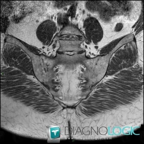 Ankylosing spondylitis, Sacro iliac joint, MRI