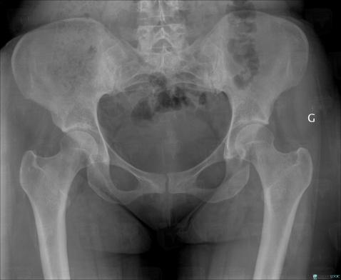 Ankylosing spondylitis, Sacro iliac joint, X rays