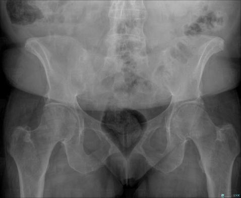 Ankylosing spondylitis, Sacro iliac joint, X rays