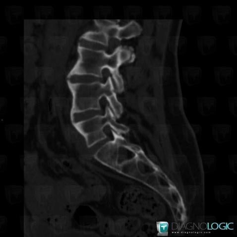 Ankylosing spondylitis, Vertebral body / Disk, CT