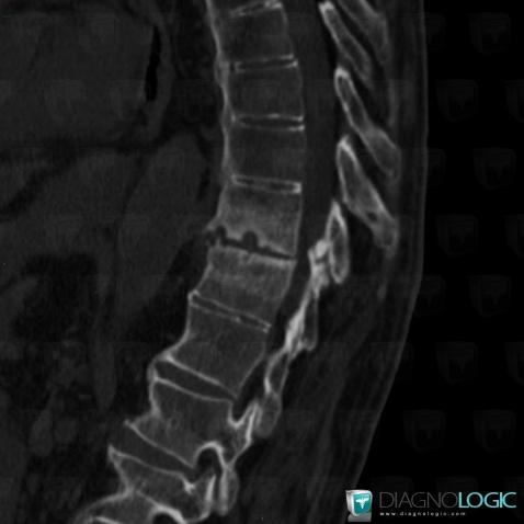 Ankylosing spondylitis, Vertebral body / Disk, CT