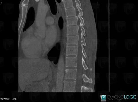 Ankylosing spondylitis, Vertebral body / Disk, CT