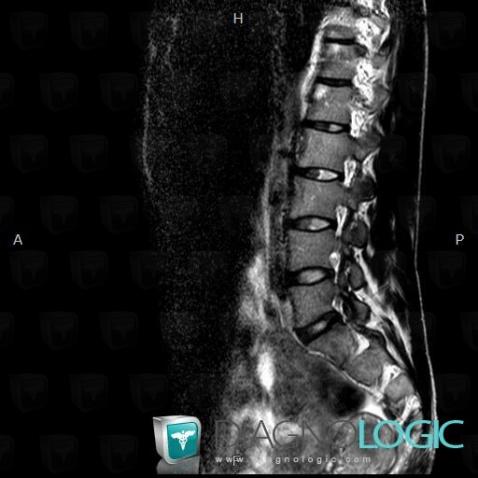 Ankylosing spondylitis, Vertebral body / Disk, MRI