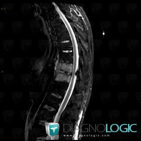 Ankylosing spondylitis, Vertebral body / Disk, MRI