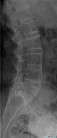 Ankylosing spondylitis, Vertebral body / Disk, X rays