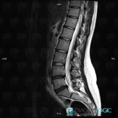 Radiology case : Annular tear (MRI) - Diagnologic