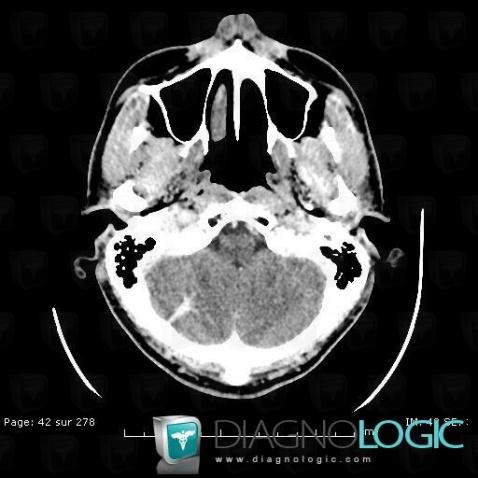 Anomalie veineuse-développement, Hémisphère cérébelleux, Fosse postérieure, TDM
