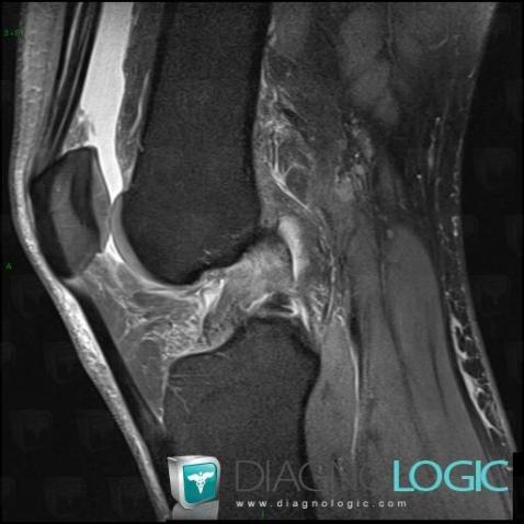 Anterior cruciate ligament rupture, Anterior cruciate ligament, MRI